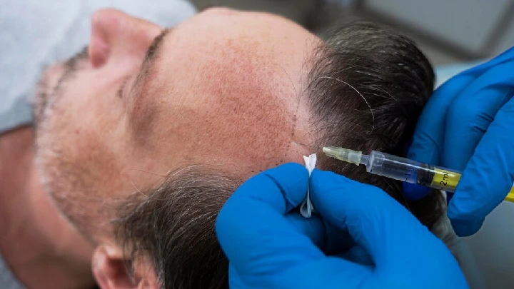 Hair restoration injection treatment for hair loss in Tampa Florida